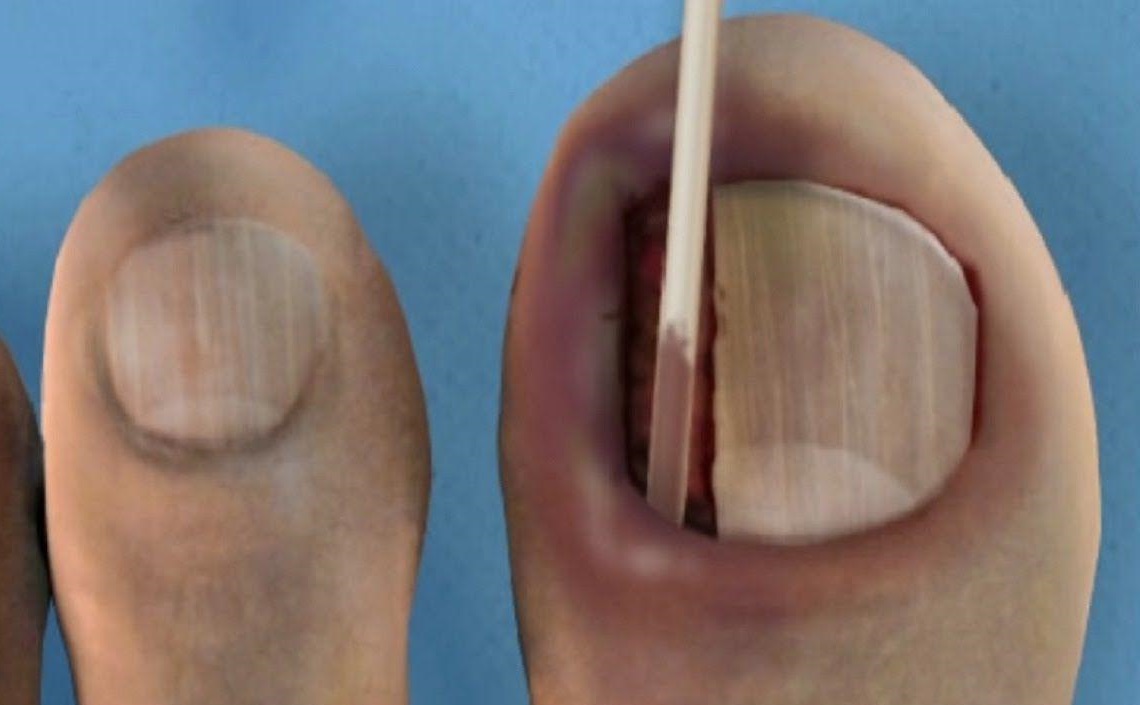 masochist: teennagel verwijderen